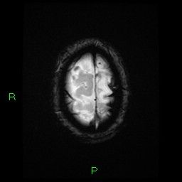 File:Cerebral amyloid angiopathy-associated lobar intracerebral hemorrhage (Radiopaedia 58376-65512 Axial Gradient Echo 3).jpg