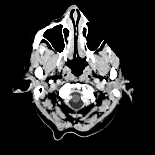 Cerebral amyloid angiopathy-related inflammation (Radiopaedia 74836-85848 Axial non-contrast 6).jpg