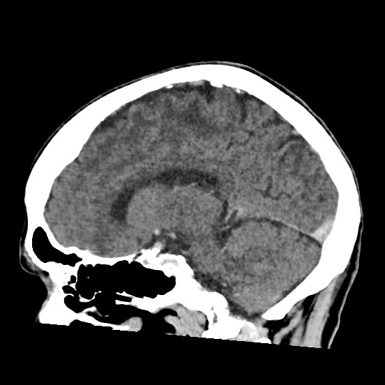 Cerebral amyloid angiopathy-related inflammation (Radiopaedia 74836-85848 C 35).jpg