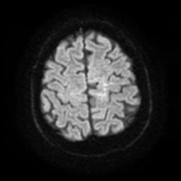 Cerebral amyloid angiopathy (Radiopaedia 28698-28978 Axial DWI 24).jpg