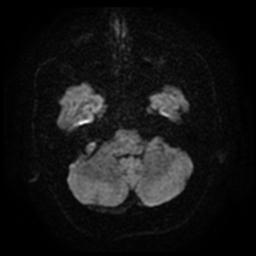 Cerebral amyloid angiopathy (Radiopaedia 28698-28978 Axial DWI 6).jpg