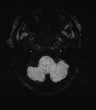 File:Cerebral amyloid angiopathy (Radiopaedia 46082-50433 Axial SWI MIP 8).png