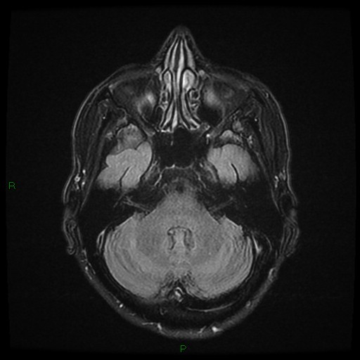 File:Cerebral amyloid angiopathy (Radiopaedia 77506-89664 Axial FLAIR 8).jpg