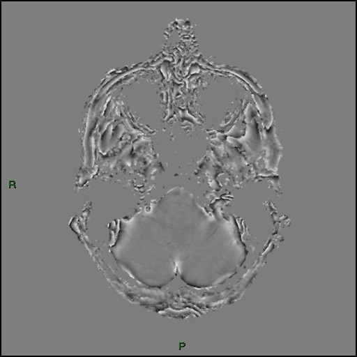 Cerebral amyloid angiopathy (Radiopaedia 77506-89664 H 20).jpg