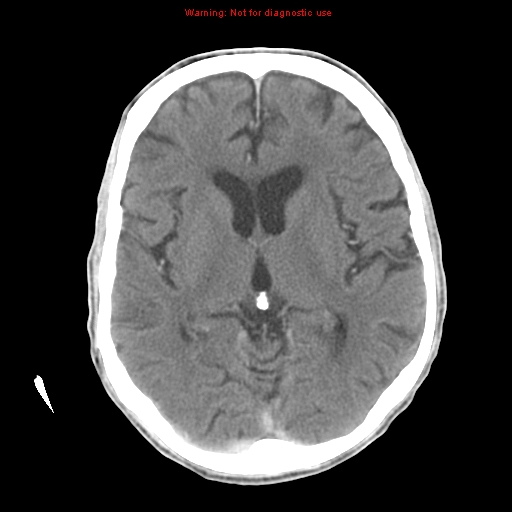 File:Cerebral and orbital tuberculomas (Radiopaedia 13308-13310 B 15).jpg