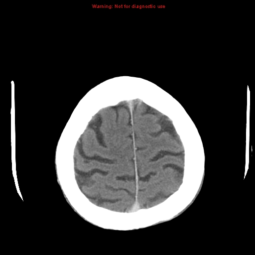 File:Cerebral and orbital tuberculomas (Radiopaedia 13308-13310 B 25).jpg