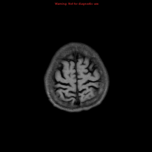 File:Cerebral and orbital tuberculomas (Radiopaedia 13308-13311 Axial T1 19).jpg