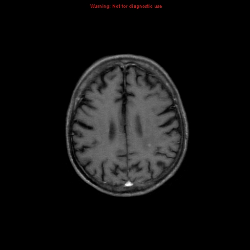 File:Cerebral and orbital tuberculomas (Radiopaedia 13308-13311 Axial T1 C+ 15).jpg