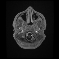 Cerebral and spinal tuberculosis (Radiopaedia 90489-107837 Axial T1 C+ 34).jpg