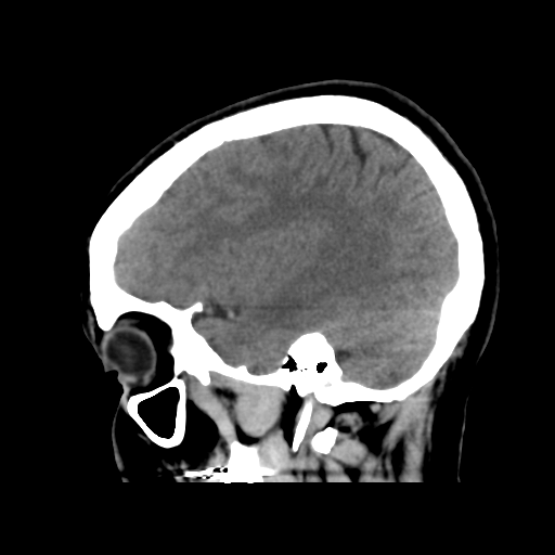 File:Cerebral arteriovenous malformation (Radiopaedia 39259-41505 B 12).png