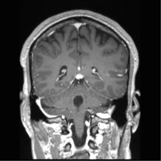 Cerebral arteriovenous malformation (Radiopaedia 39259-41506 Coronal T1 C+ 35).png