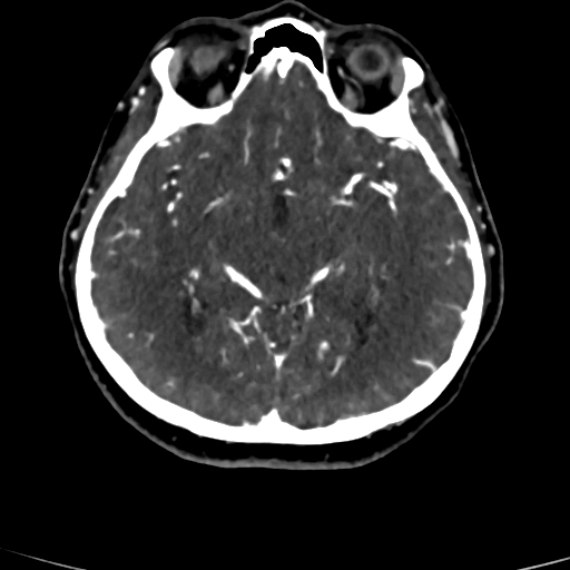 Cerebral arteriovenous malformation (Radiopaedia 73830-84645 Axial C+ delayed 52).jpg