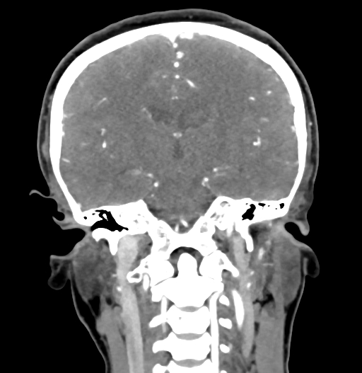 Cerebral arteriovenous malformation (Radiopaedia 73830-84645 C 55).jpg