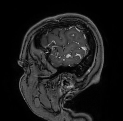 Cerebral arteriovenous malformation (Radiopaedia 74411-85654 Sagittal T1 C+ 9).jpg
