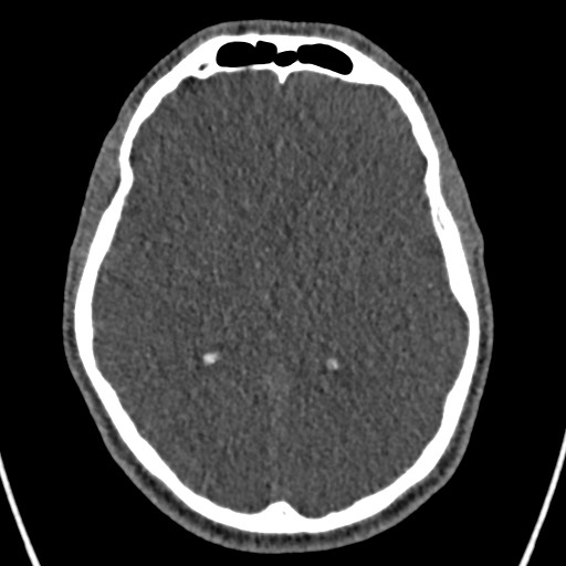 Cerebral arteriovenous malformation (Radiopaedia 78188-90746 Axial non-contrast 91).jpg