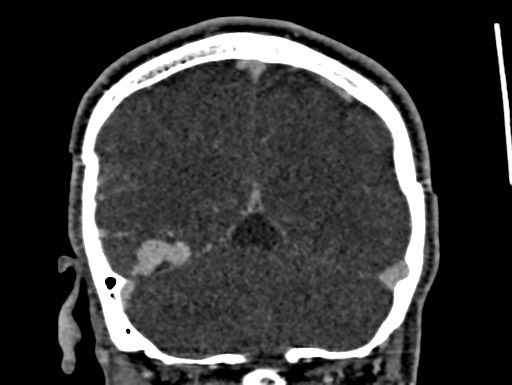 Cerebral arteriovenous malformation (Radiopaedia 78188-90746 Coronal C+ delayed 96).jpg