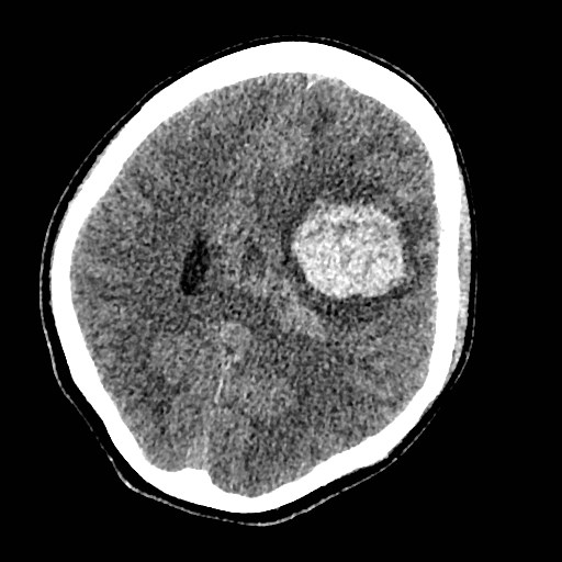 Cerebral arteriovenous malformation (Radiopaedia 79677-92887 Axial non-contrast 25).jpg