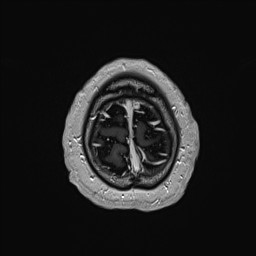 Cerebral arteriovenous malformation (Radiopaedia 84015-99245 Axial T1 C+ 142).jpg