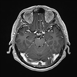 Cerebral arteriovenous malformation (Radiopaedia 84015-99245 Axial T1 C+ 61).jpg