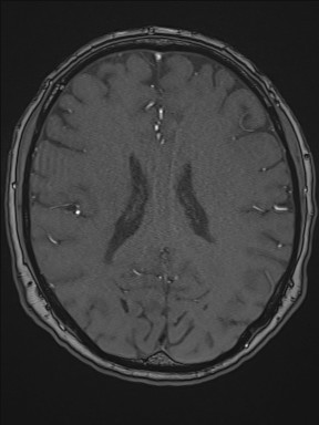 File:Cerebral arteriovenous malformation (Radiopaedia 84015-99245 Axial TOF 147).jpg