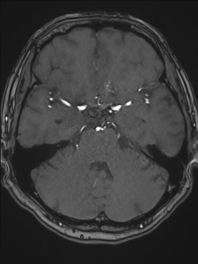 File:Cerebral arteriovenous malformation (Radiopaedia 84015-99245 Axial TOF 93).jpg