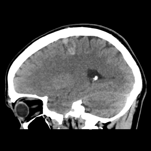 Cerebral arteriovenous malformation (Spetzler-Martin grade 2) (Radiopaedia 41262-44076 A 24).png