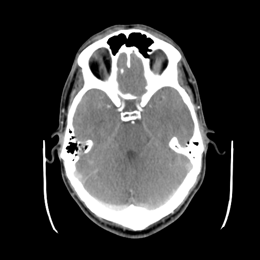 Cerebral arteriovenous malformation (Spetzler-Martin grade 2) (Radiopaedia 41262-44076 Axial C+ 17).png