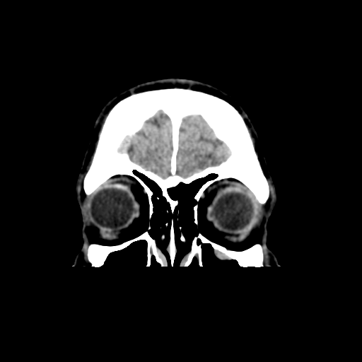 Cerebral arteriovenous malformation (Spetzler-Martin grade 2) (Radiopaedia 41262-44076 Coronal non-contrast 7).png
