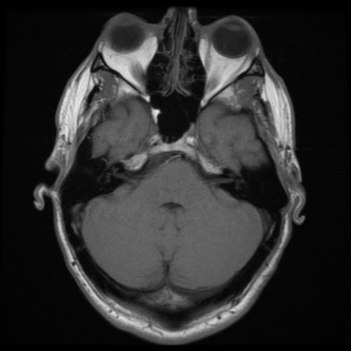 File:Cerebral arteriovenous malformation (Spetzler-Martin grade 2) (Radiopaedia 41262-44092 Axial T1 4).png
