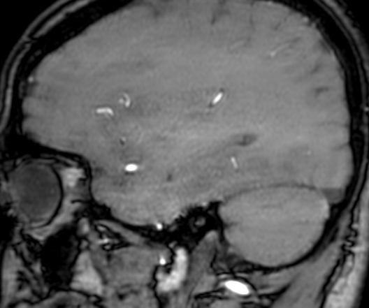 Cerebral arteriovenous malformation at posterior body of corpus callosum (Radiopaedia 74111-84925 J 294).jpg
