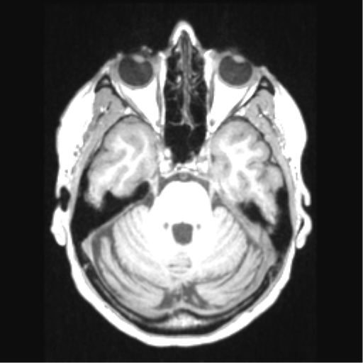 Cerebral arteriovenous malformation with hemorrhage (Radiopaedia 34422-35737 Axial T1 24).png