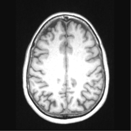 Cerebral arteriovenous malformation with hemorrhage (Radiopaedia 34422-35737 Axial T1 53).png