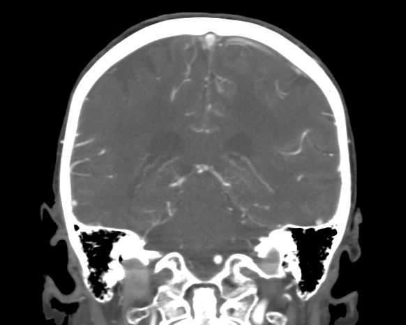 Cerebral arteriovenous malformation with lobar hemorrhage (Radiopaedia 44725-48511 A 37).png