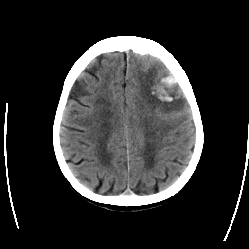 File:Cerebral arteriovenous malformation with lobar hemorrhage (Radiopaedia 44725-48512 Axial non-contrast 25).png