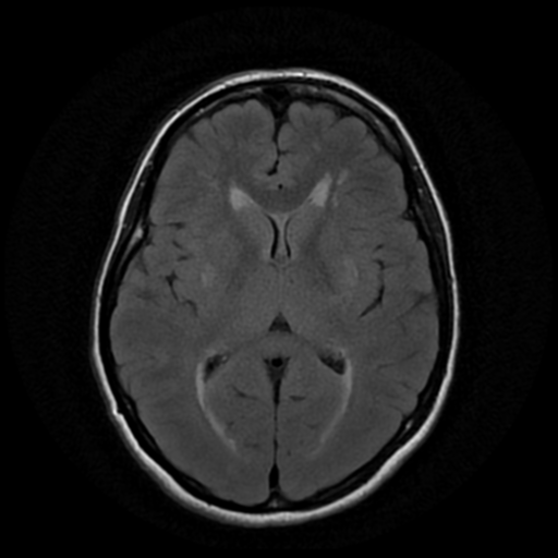 File:Cerebral autosomal dominant arteriopathy with subcortical infarcts and leukoencephalopathy (CADASIL) (Radiopaedia 41018-43768 AX FLAIR (Propeller) 11).png