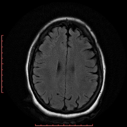 File:Cerebral cavernous malformation (Radiopaedia 26177-26306 FLAIR 15).jpg