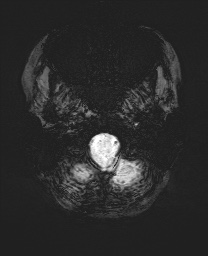 Cerebral cavernous venous malformation (Radiopaedia 70008-80021 Axial SWI 3).jpg