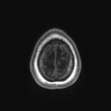 Cerebral cavernous venous malformation (Radiopaedia 70008-80021 Axial T1 91).jpg