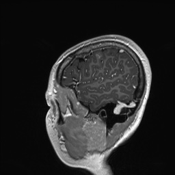 Cerebral cavernous venous malformation (Radiopaedia 70008-80021 Sagittal T1 C+ 10).jpg