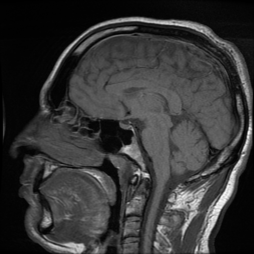 File:Cerebral cavernous venous malformation (Zabramski type II) (Radiopaedia 85511-101198 Sagittal T1 18).jpg