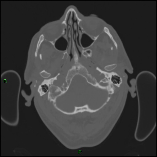Cerebral contusions (Radiopaedia 33868-35039 Axial bone window 22).jpg