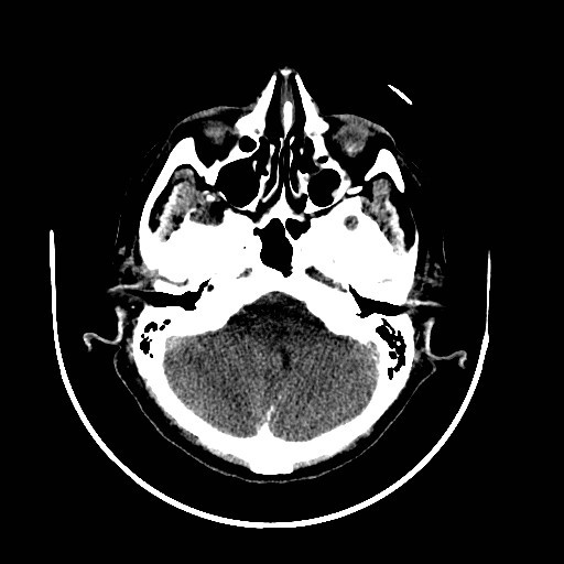 Cerebral edema (evolution in time) (Radiopaedia 19418-19439 non-contrast 21).jpg