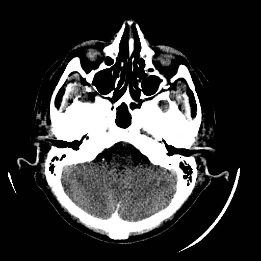 File:Cerebral edema (evolution in time) (Radiopaedia 19418-19440 non-contrast 23).jpg