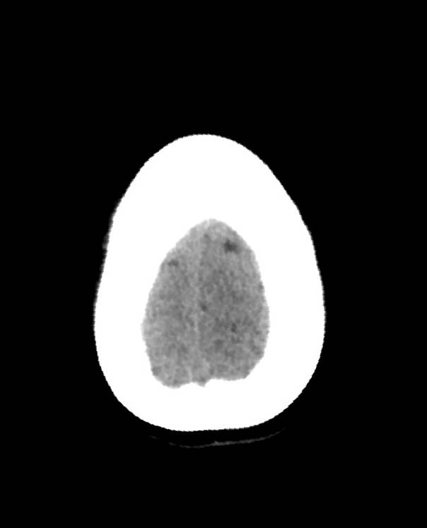 Cerebral edema due to severe hyponatremia (Radiopaedia 89826-106938 Axial non-contrast 92).jpg
