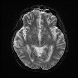 Cerebral embolic infarcts (embolic shower) (Radiopaedia 72391-82921 Axial DWI 13).jpg