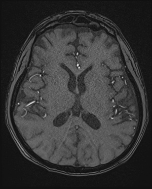 Cerebral embolic infarcts (embolic shower) (Radiopaedia 72391-82921 Axial MRA 106).jpg