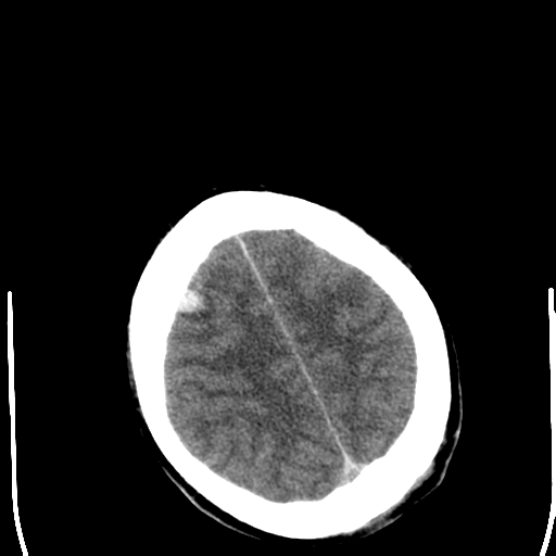 File:Cerebral hemorrhagic contusions- temporal evolution (Radiopaedia 40224-42752 Axial non-contrast 24).png
