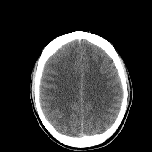 File:Cerebral hemorrhagic contusions- temporal evolution (Radiopaedia 40224-42753 Axial non-contrast 23).png