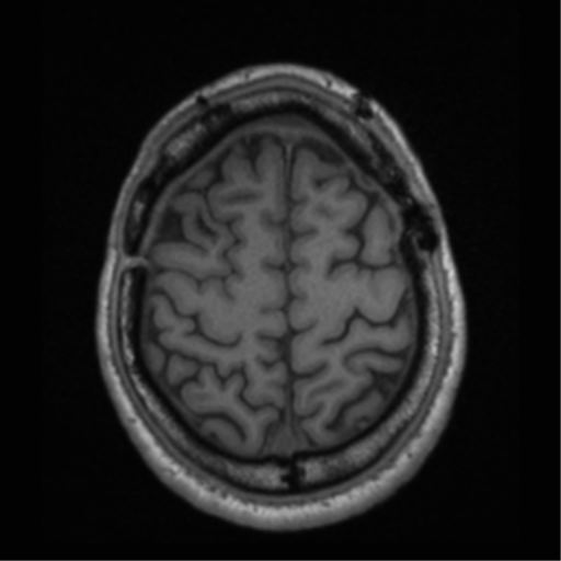 Cerebral hemorrhagic contusions- temporal evolution (Radiopaedia 40224-42757 Axial T1 64).png