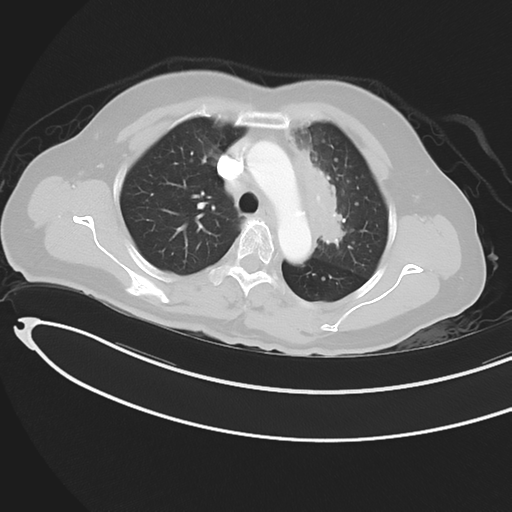 Cerebral metastases (Radiopaedia 33041-34055 Axial lung window 18).png